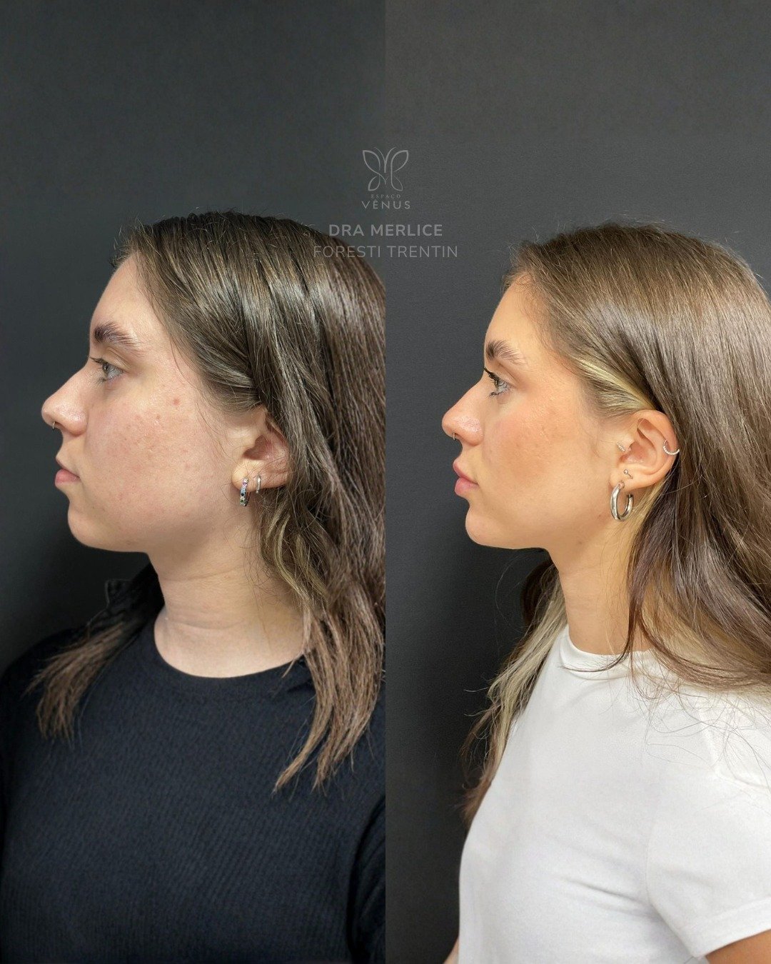 A Ana me procurou porque sentia que o formato do rosto deixava sua imagem mais infantil. Com peq (1)