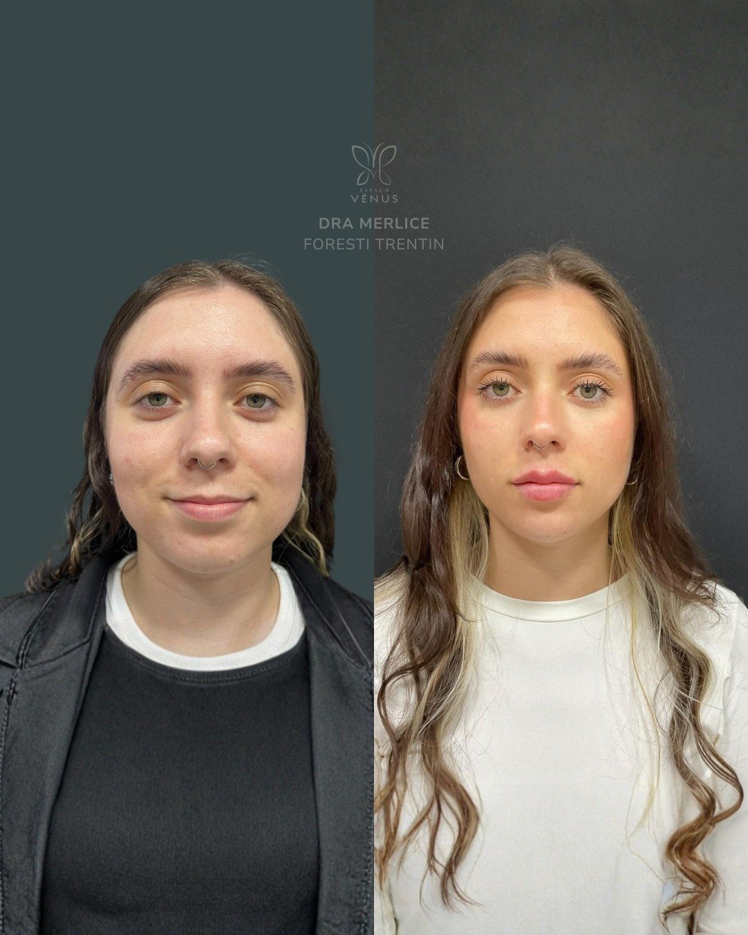A Ana me procurou porque sentia que o formato do rosto deixava sua imagem mais infantil. Com peq