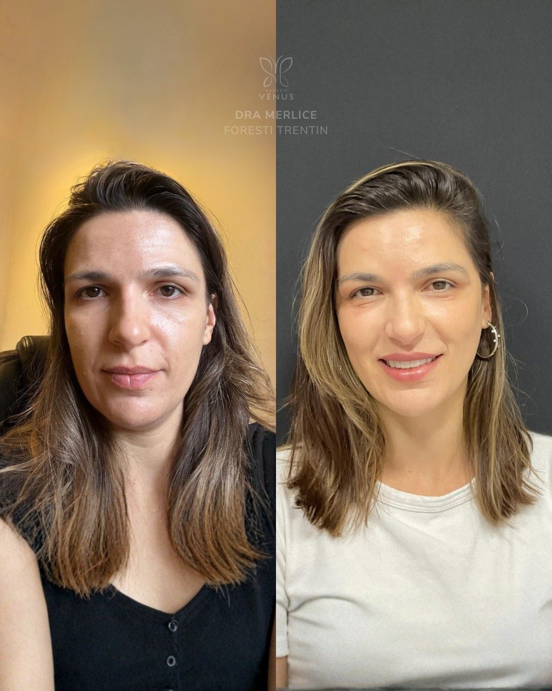 A Haiala me procurou porque sentia o rosto “derretido” e já não gostava mais do formato que via