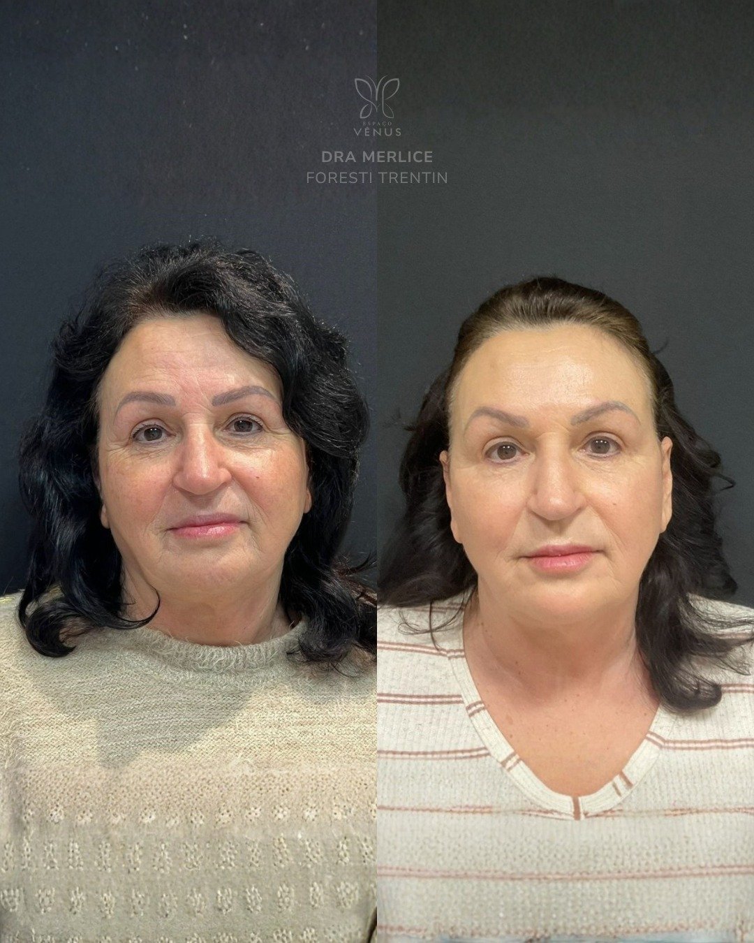 A Íris chegou com um pedido muito claro- rejuvenescer, cuidar da pele, mas sem perder quem ela é