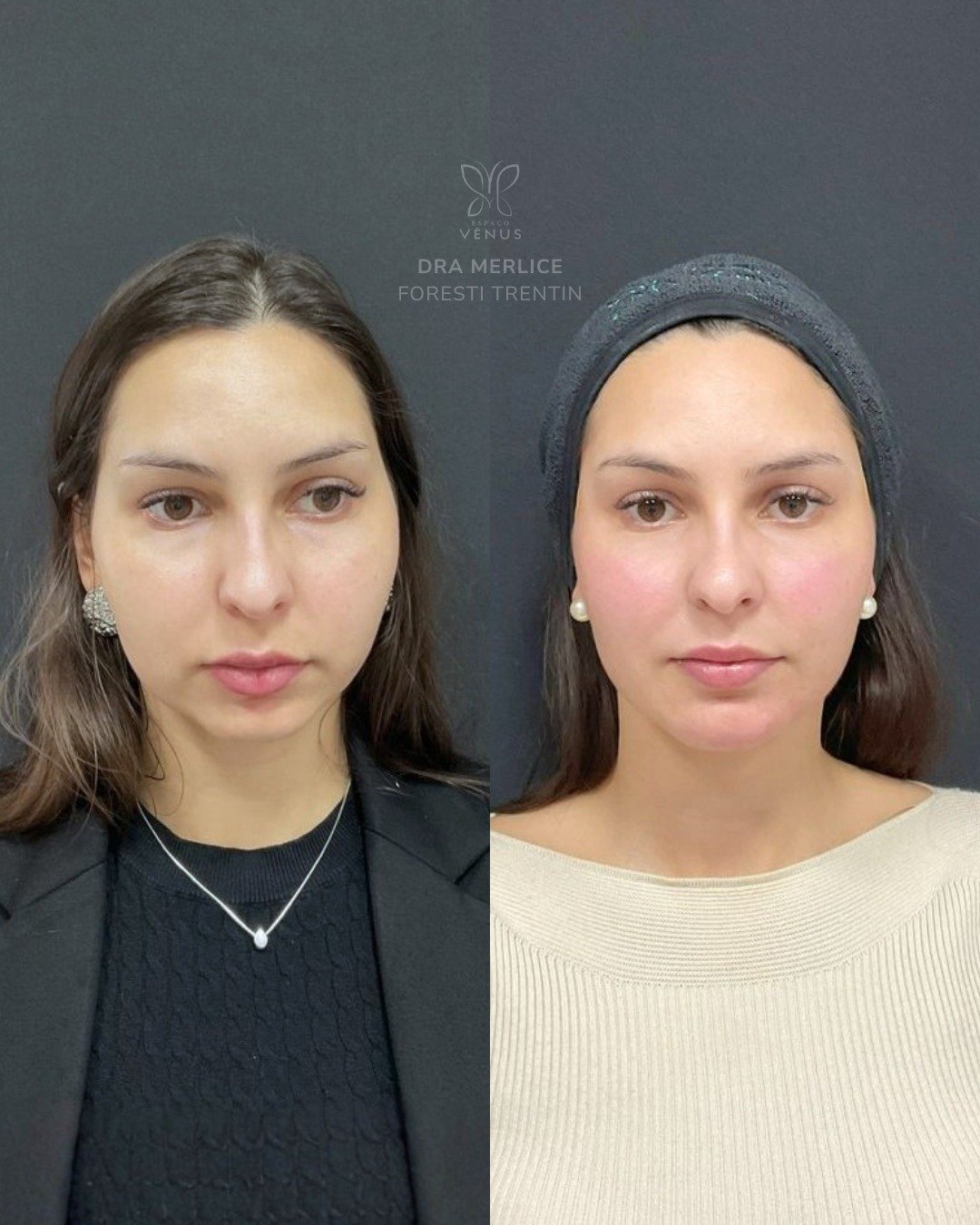 A Keila me procurou dizendo que sentia o rosto “gordo”. Mas, na verdade, não era sobre volume. E