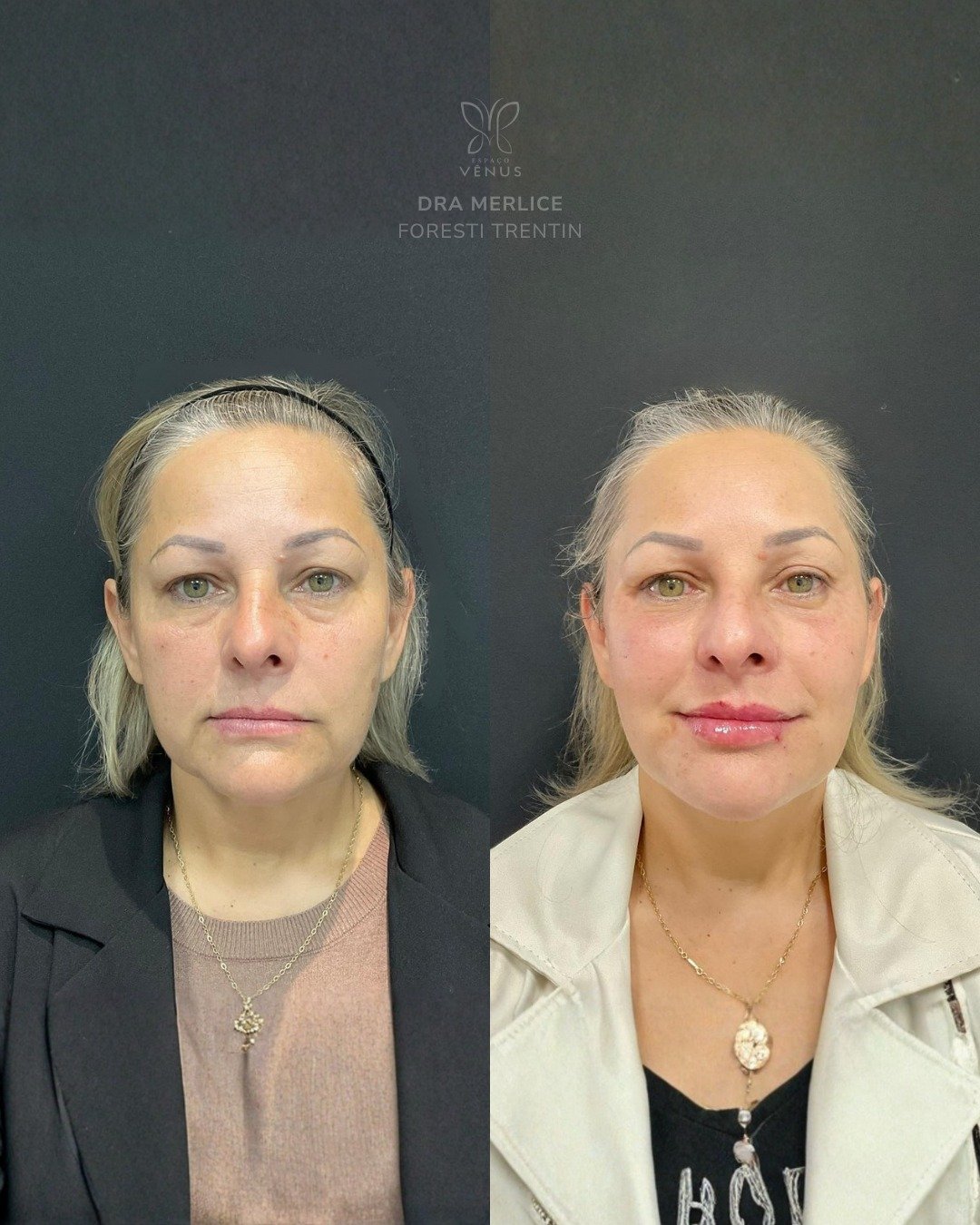 A Virgínia tinha a mesma queixa que escuto de muitas mulheres- aparência cansada, mesmo dormindo