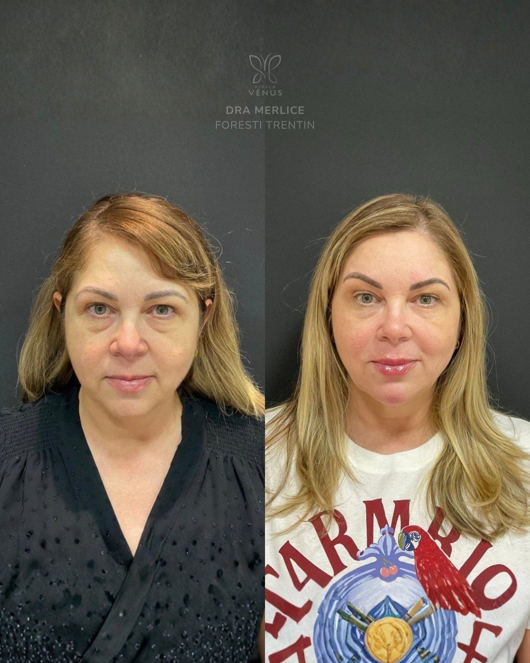 Antes, a Silvana se olhava no espelho e sentia que o rosto não refletia como ela realmente se se