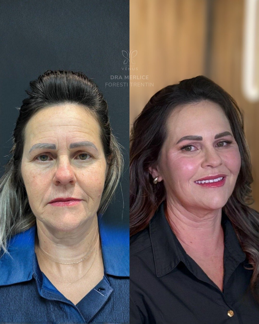 Ela chegou dizendo algo muito comum no consultório-“Eu estou bem, mas meu rosto parece sempre ca