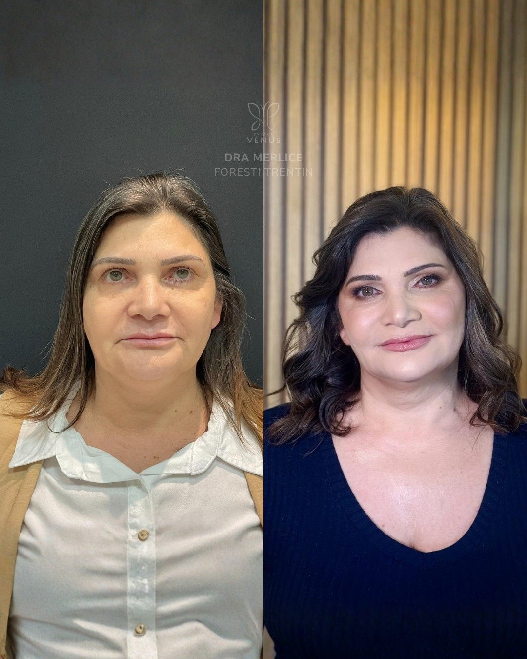 Ela me procurou incomodada com o contorno do lábio, que deixava a expressão “triste”, e com as p