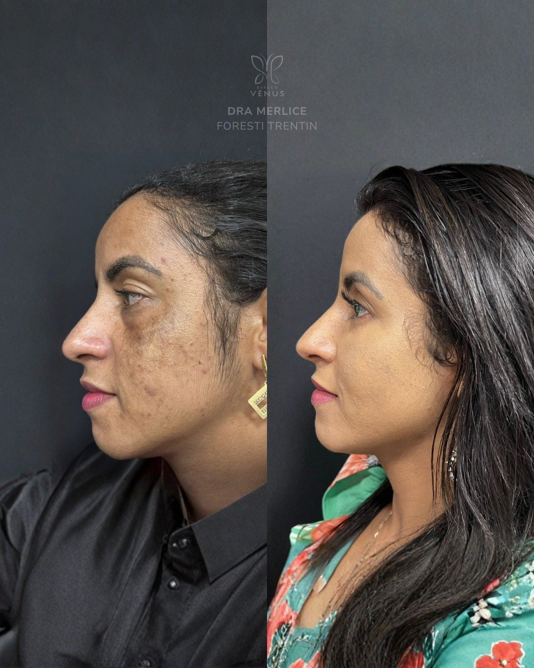 Ela me procurou porque as manchas de melasma estavam afetando não só a pele, mas a autoestima. M (1)