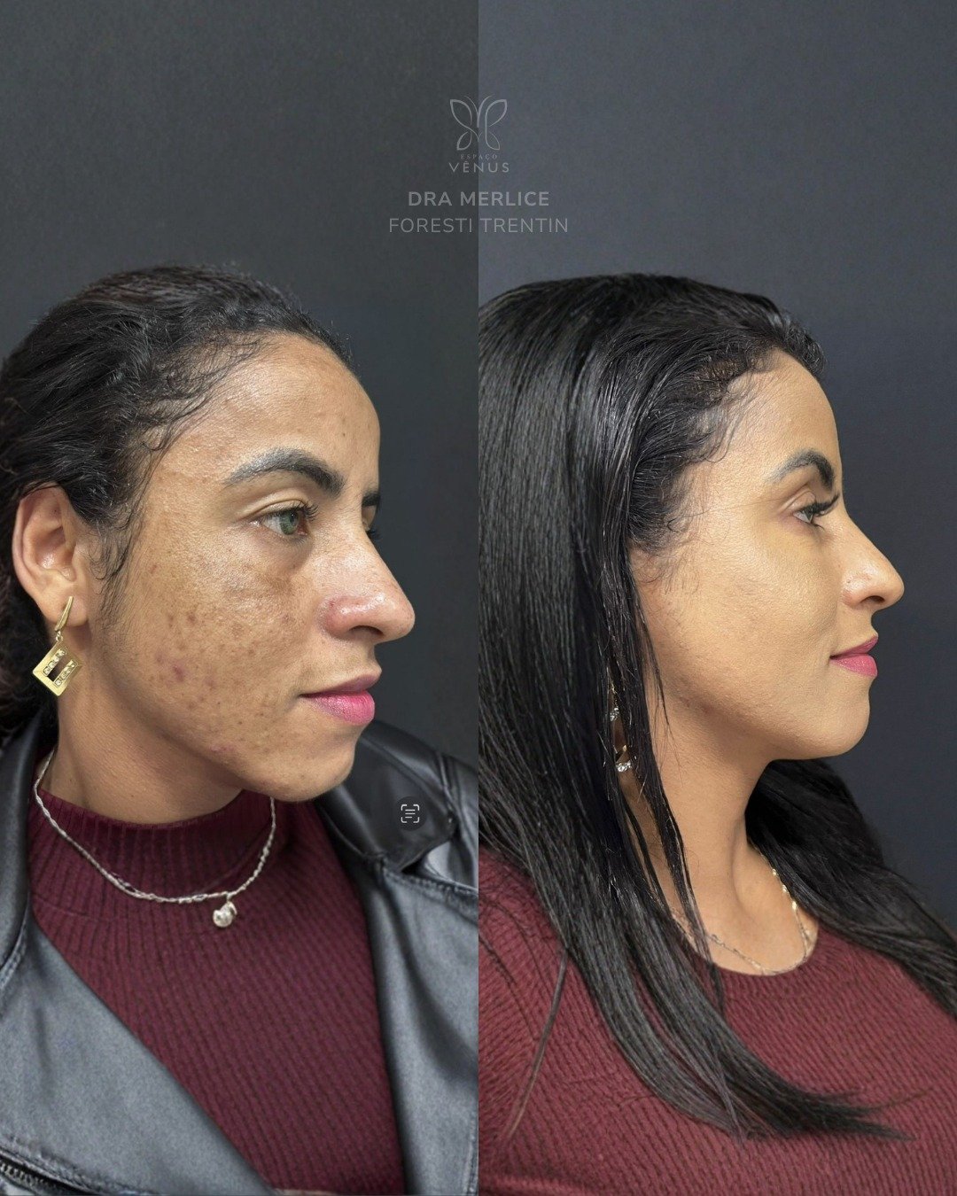 Ela me procurou porque as manchas de melasma estavam afetando não só a pele, mas a autoestima. M (2)