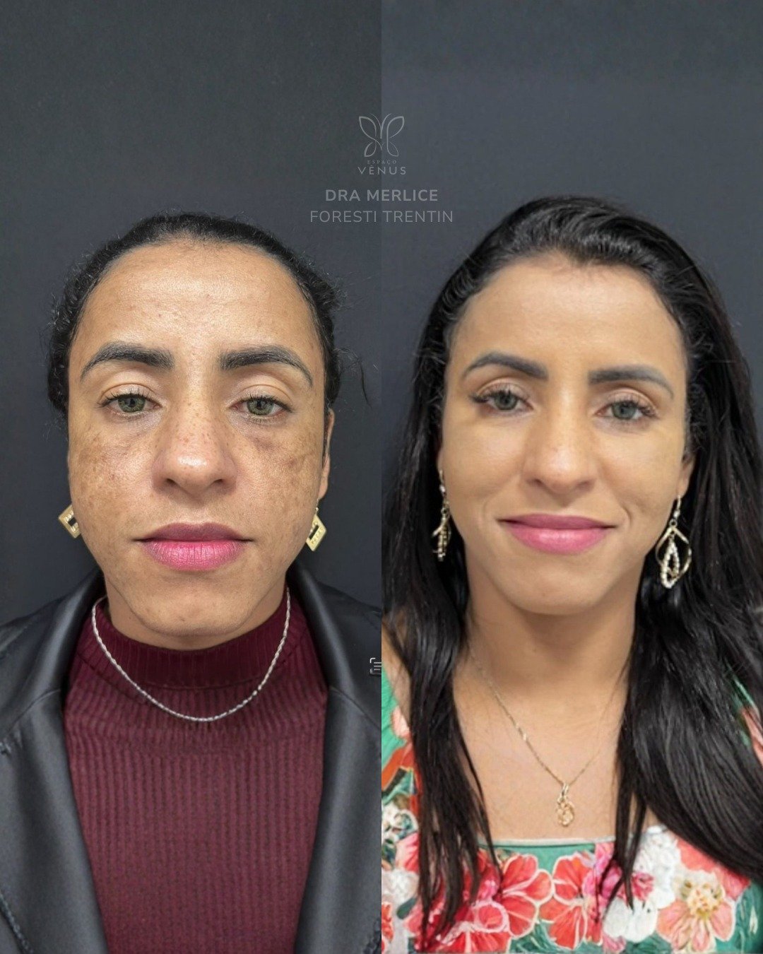 Ela me procurou porque as manchas de melasma estavam afetando não só a pele, mas a autoestima. M