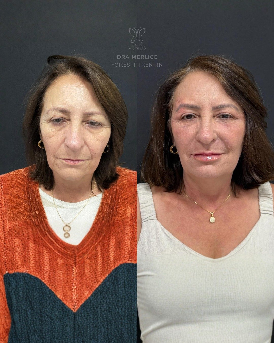 Ela me procurou porque sentia que o rosto estava “derretendo” e queria rejuvenescer sem perder a