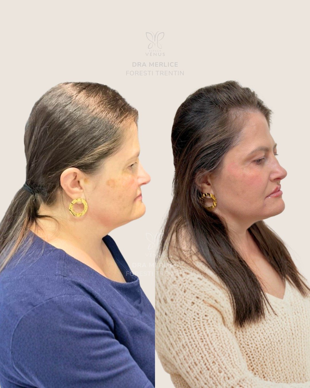 Ela não se sentia confortável com o próprio perfil.Não era algo que os outros percebiam tanto. M