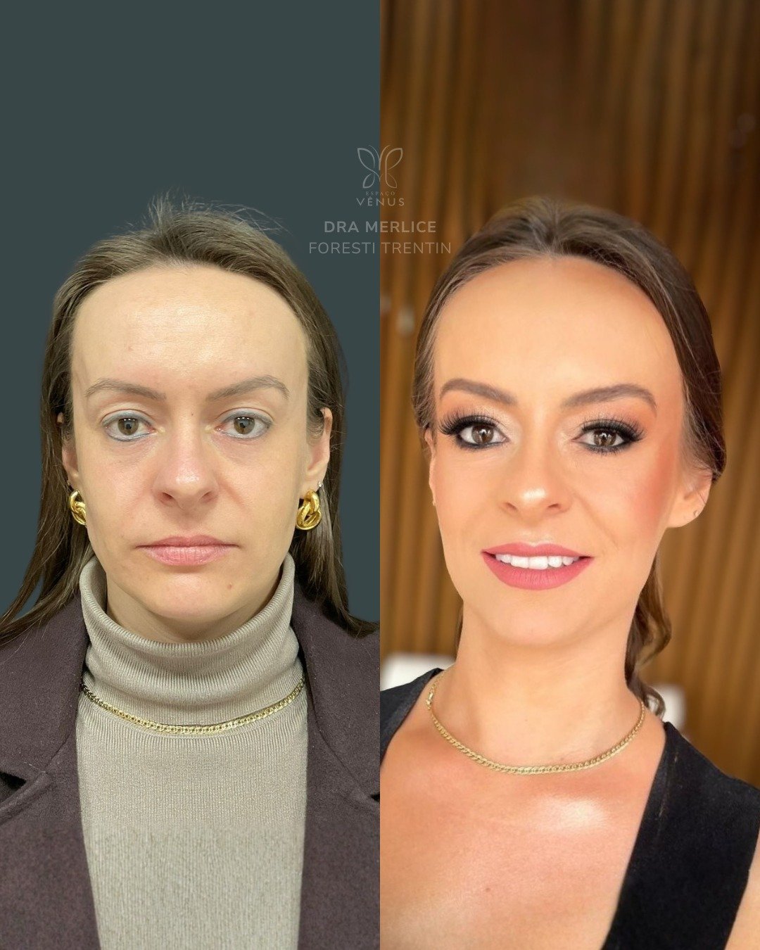 Ela queria amenizar o aspecto de cansada que o rosto transmitia, mesmo sendo jovem. A proposta d (1)