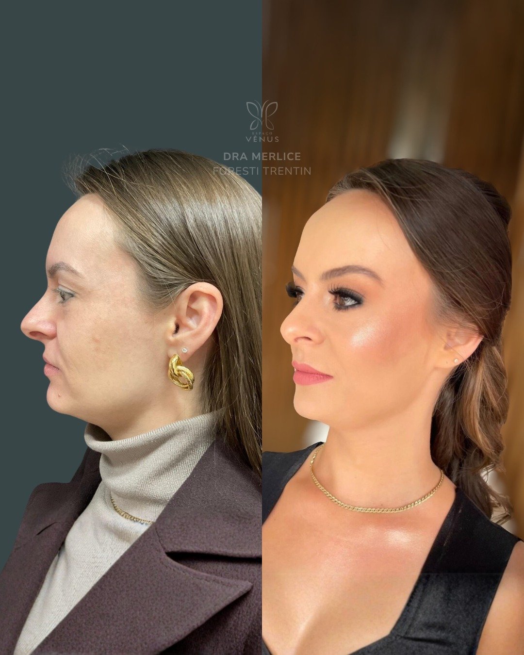 Ela queria amenizar o aspecto de cansada que o rosto transmitia, mesmo sendo jovem. A proposta d