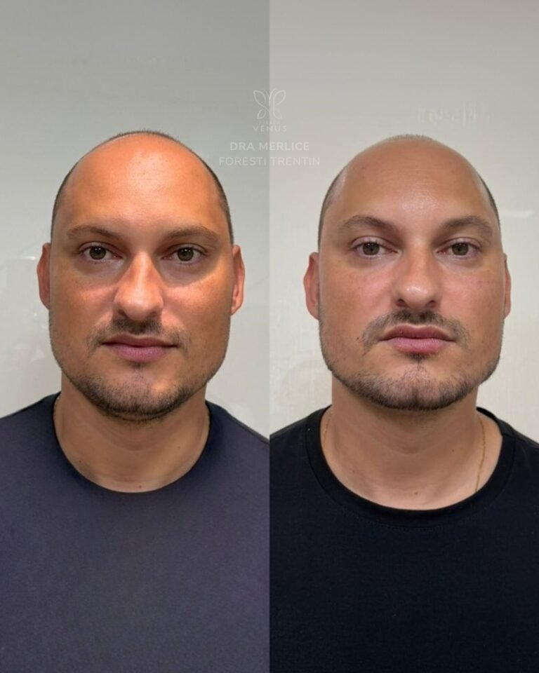 Ele chegou com um desejo muito claro- um rosto mais marcante, mais firme, com presença e, claro