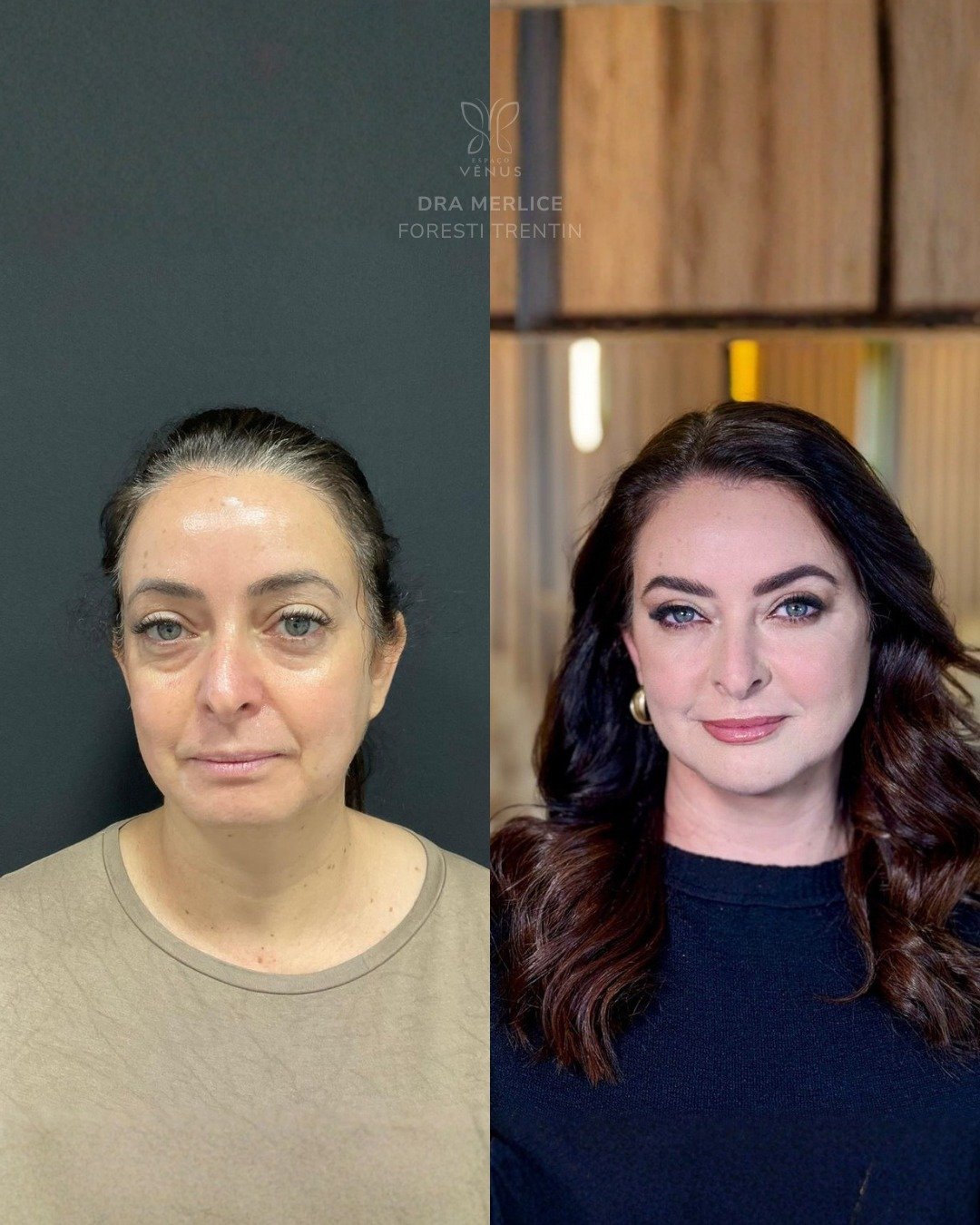 O olhar dela sempre foi bonito.Mas o excesso de pele na região dos olhos, junto com bolsas mais (1)