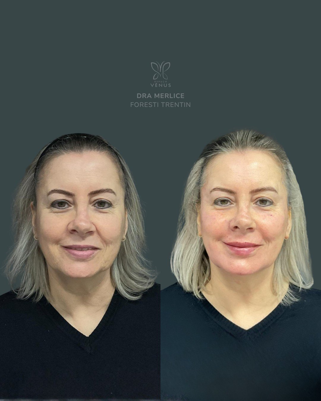 Um toque sutil.Um detalhe ajustado com estratégia.Com o Método Chique, não foi sobre mudar o ros